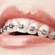 ارتودنسی چه چیز سبب بروز حساسیت دندان می‌شود؟ چه چیز سبب بروز حساسیت دندان می‌شود؟ index braces 80x80