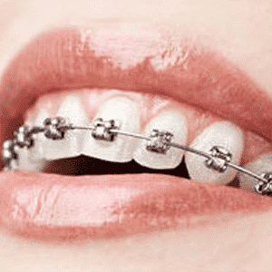 ارتودنسی  انتخاب روکش مناسب برای دندان index braces