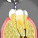 کانال ریشه  مراقبت های پس از ایمپلنت دندان root canal treatment 80x80