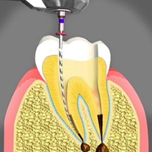 کانال ریشه [object object] مراقبت های پس از درمان ریشه root canal treatment