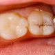 پوسیدگی دندان آراسته  اشتباهات هنگام مسواک زدن arasteh1 80x80