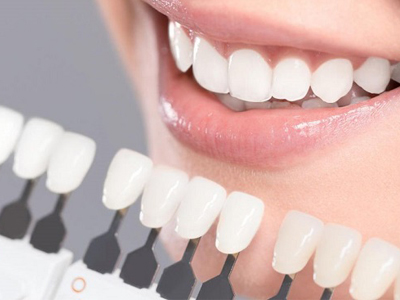 روکش دندان کلینیک دندانپزشکی آراسته  سه چالش پیش رو در انجام ونیر و راه حل مقابله با آن ها 4