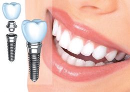 کلینیک دندانپزشکی آراسته [object object] مراقبت های پس از درمان ریشه 8 260x185  مطالب دندانپزشکی 8 260x185