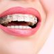 کلینیک دندانپزشکی آرسته در شیراز  کشیدن دندان عقل 11 80x80