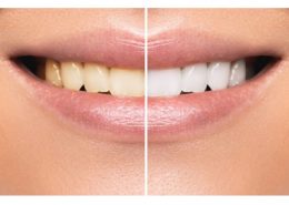 کلینیک دندانپزشکی آرسته [object object] مراقبت های پس از درمان ریشه 15 260x185  مطالب دندانپزشکی 15 260x185