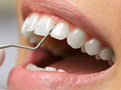 کلینیک تخصصی دندانپزشکی آرسته  آیا جرم گیری باعث صدمه به دندان ها می شود؟ 20