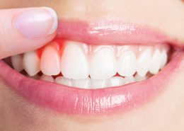 بیماری لثه [object object] مراقبت های پس از درمان ریشه gum 260x185  مطالب دندانپزشکی gum 260x185