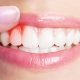 بیماری لثه  سالم نگه داشتن دندان ها gum 80x80