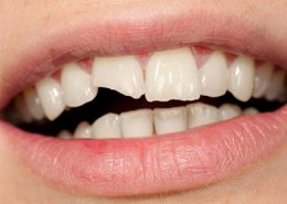 کلینیک دندانپزشکی آرسته [object object] مراقبت های پس از درمان ریشه 23 260x185  مطالب دندانپزشکی 23 260x185