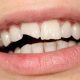 کلینیک دندانپزشکی آرسته  آیا می توان برای رفع کجی دندان از درمان لمینت دندان استفاده کرد؟ 23 80x80