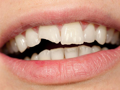 کلینیک دندانپزشکی آرسته  دلایل شکستگی و ترک خوردگی دندان ها 23