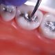دندانپزشکی آرسته در شیراز  دلایل شکستگی و ترک خوردگی دندان ها 24 80x80
