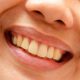 دندانپزشکی آرسته در شیراز  علت لق شدن دندان ها در سنین بزرگسالی 34 80x80