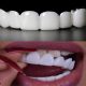 کامپوزیت در ترمیم و پرکردن دندان snap 80x80
