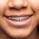 کامپوزیت در ترمیم و پرکردن دندان orthodontic 80x80