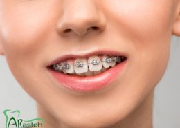 [object object] مراقبت های پس از درمان ریشه protrogen 260x185  مطالب دندانپزشکی protrogen 260x185