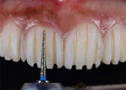 تراشیدن دندانها برای نصب لمینت [object object] مراقبت های پس از درمان ریشه Untitled 1 1 260x185  مطالب دندانپزشکی Untitled 1 1 260x185
