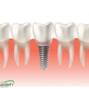 پیش‌نویس خودکار کش ارتودنسی taj implant 180x180