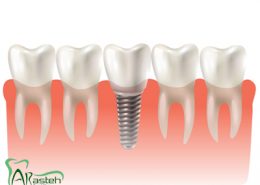 [object object] مراقبت های پس از درمان ریشه taj implant 260x185  مطالب دندانپزشکی taj implant 260x185