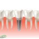 افزایش طول تاج دندان taj implant 80x80