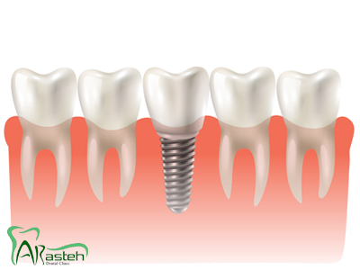 ترمیم و زیبایی دندانپزشکی ترمیمی و زیبایی taj implant