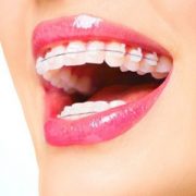 ارتودنسی و تغییر فرم لب ها پیش‌نویس خودکار پری کرونیت چیست؟ Untitled 1 1 180x180