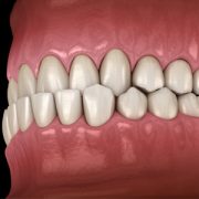 اندربایت چیست؟ پیش‌نویس خودکار بین هر ویزیت دندانپزشکی چه کنیم؟ Untitled 1 3 180x180