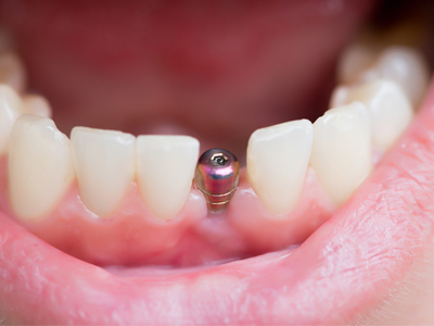 ایمپلنت بدون جراحی  سیاهی دندان ناشی از قطره آهن Untitled 1 1