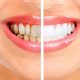 تفاوت بلیچینگ و جرمگیری دندان  چه کنیم دندانهایمان دچار حساسیت نشوند Untitled 1 1 80x80