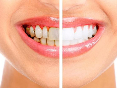 تفاوت بلیچینگ و جرمگیری دندان  سیاهی دندان ناشی از قطره آهن Untitled 1 1