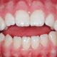پریودنتیت دندان عقل نقش دندان عقل در دهان Untitled 1 1 80x80