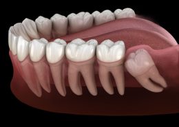 نقش دندان عقل در دهان [object object] مراقبت های پس از درمان ریشه Untitled 1 2 260x185  مطالب دندانپزشکی Untitled 1 2 260x185