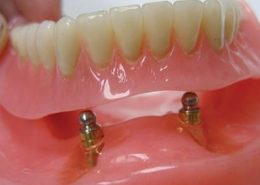 ایمپلنت نگهدارنده دست دندان [object object] مراقبت های پس از درمان ریشه Untitled 1 260x185  مطالب دندانپزشکی Untitled 1 260x185