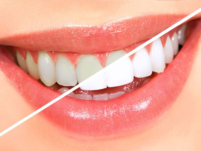 سفید کردن دندانها  سیاهی دندان ناشی از قطره آهن Untitled 1 3