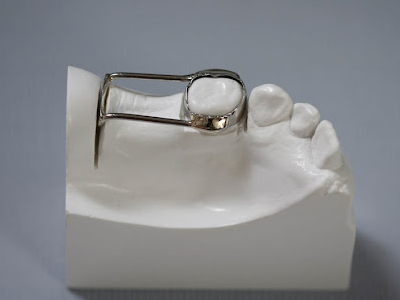 فضا نگه دار چیست دندانپزشکی آرسته فضا نگه دار چیست Untitled 1 1
