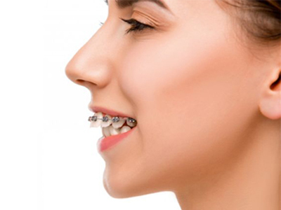 اختلال اورجت دندانپزشکی آرسته فضا نگه دار چیست Untitled 1 1