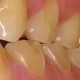 سایش شیمیایی دندان ها اورجت اختلال اورجت Untitled 1 80x80