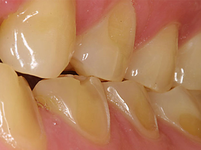 سایش شیمیایی دندان ها  ارتودنسی و تغییر فرم لب ها Untitled 1