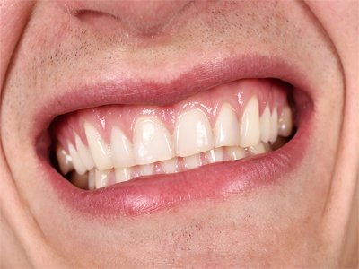 شاخص شاخص شاخص بررسی عوامل بیماری در لثه دندانپزشکی آرسته بررسی عوامل بیماری در لثه