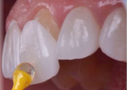 روکش ایمکس دندان [object object] مراقبت های پس از درمان ریشه Untitled 1 2 260x185  مطالب دندانپزشکی Untitled 1 2 260x185