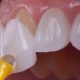 روکش ایمکس دندان ایمپلنت با لیزر درمان ایمپلنت با لیزر Untitled 1 2 80x80