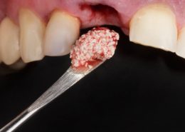 پیوند استخوان در ایمپلنت [object object] مراقبت های پس از درمان ریشه Untitled 1 3 260x185  مطالب دندانپزشکی Untitled 1 3 260x185