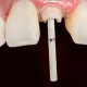 پست و کور چیست؟ پروتز دندان فاکتور های موثر در تعیین نوع پروتز Untitled 1 80x80