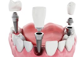 کاشت ایمپلنت دندان در بهترین دندانپزشکی شیراز [object object] مراقبت های پس از درمان ریشه          260x185  مطالب دندانپزشکی  D8 B4 D8 A7 D8 AE D8 B5 260x185