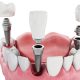 کاشت ایمپلنت دندان در بهترین دندانپزشکی شیراز دندانپزشکی در چه شرایطی نمی توان درمان ایمپلنت دندان را انجام داد          80x80
