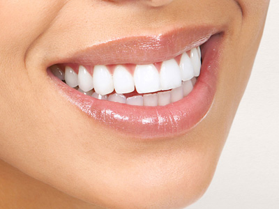 مراقبت های توصیه شده بعد از درمان کامپوزیت لمینت دندان ضخامت لمینت دندان Untitled 1 1