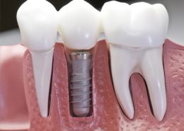 دندان مصنوعی به ایمپلنت [object object] مراقبت های پس از درمان ریشه Untitled 1 3 260x185  مطالب دندانپزشکی Untitled 1 3 260x185