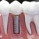 دندان مصنوعی به ایمپلنت  بهترین مواد برای ایمپلنت دندان Untitled 1 3 80x80