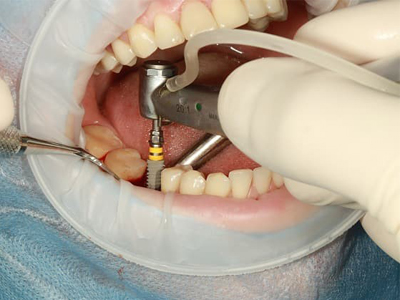 انواع ایمپلنت دندان  انواع ایمپلنت دندان Untitled 1