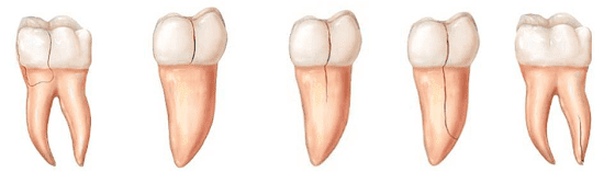 درمان ترک خوردگی دندان anva tarak dandan